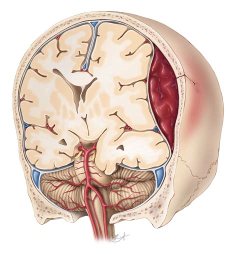 Epidural Hematoma | The Neurosurgical Atlas