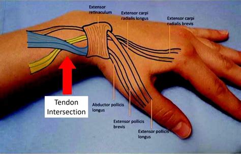 What is Intersection Syndrome? - Regenexx