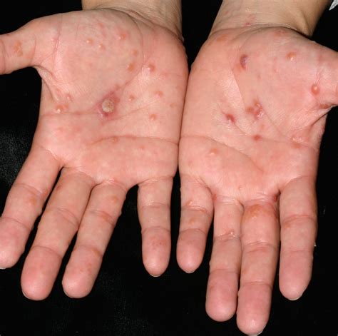 List 92+ Pictures Pictures Of Dyshidrotic Eczema On Hands Updated