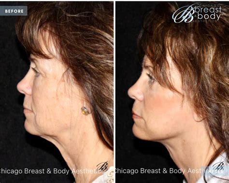 Scarless Neck Lift | Facial Plastic Surgeon 30+ Years Experience