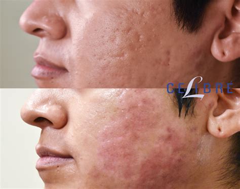 Acne Scar Removal Before and After Pictures of Actual Patients