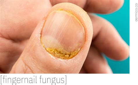 Fingernail Fungus | HAND & NAIL CARE