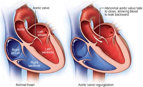 Mitral Valve Prolapse With Regurgitation