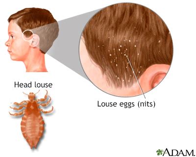 Head lice Information | Mount Sinai - New York