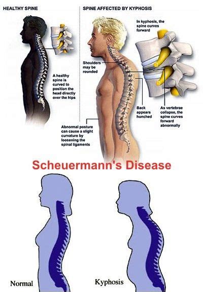 Scheuermann’s disease : causes, symptoms & treatments | Global ...