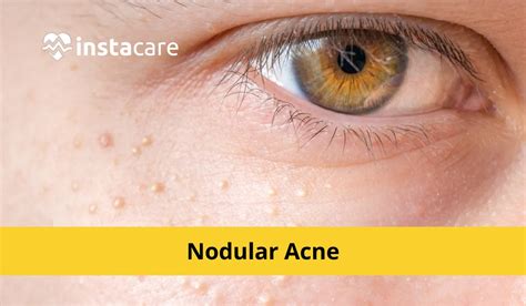 Nodular Acne: Causes, Treatment, Home Remedies And Prevention Zwivel ...