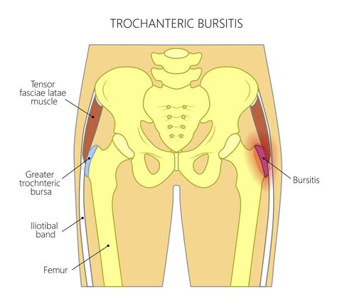 diagram of hip bursitis Hip Bursitis Exercises, Bursitis Hip, Hip ...