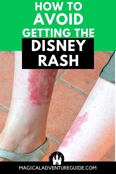 The Disney Rash: A Nurse's Tips for Preventing and Treating It ...