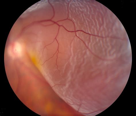 Retinal Detachment: Causes, Symptoms, and Treatments