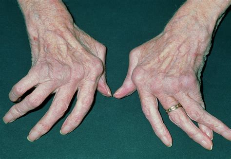 Woman's Hands Crippled With Rheumatoid Arthritis Photograph by Dr P ...