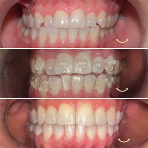 Clear aligners in orthodontics | Orthodontics, Teeth bleaching, Invisalign