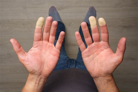 Raynaud’s Syndrome – Symptoms and Treatment Options - WWMG Blog