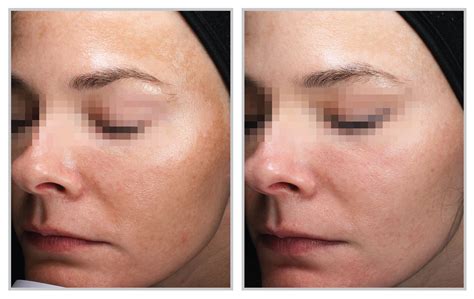 Tips For Taking The Best Before-And-After Photos Of Your Skin ...