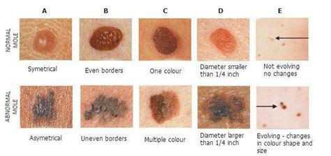 ABCDEF's of Changing Moles & Melanoma