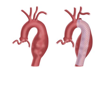 Minimally Invasive Aortic Aneurysm Repair | UPMC Heart & Vascular