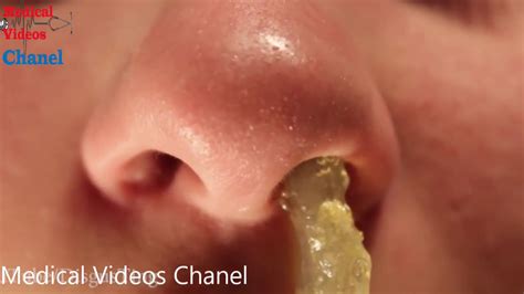 Medical - Huge Booger Inside Nose Removal- Medical - YouTube