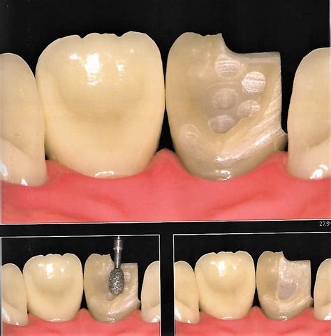 Anterior Crown Preparation | Dental Esthetics