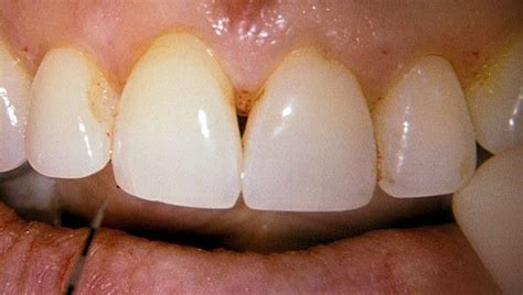 Papilla Reconstruction | Dr. Peter Nordland | Periodontist