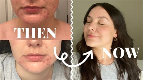 how i cured my hormonal acne in 4 months with tretinoin: before and ...