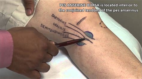 Pes Anserine Bursitis Injection - YouTube