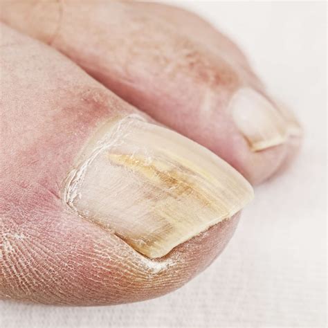 Chemical Avulsion Of Fungal Nails Using Urea, 52% OFF