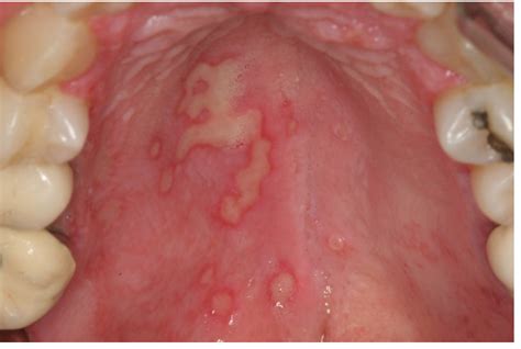 Herpetic Gingivostomatitis Palate