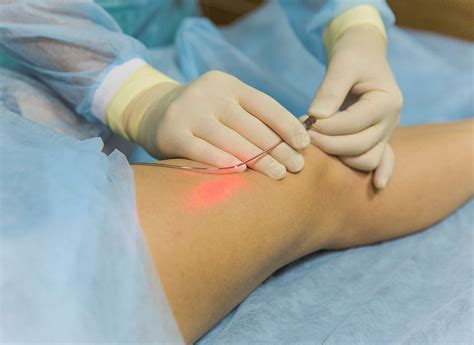 What is a Endovenous Laser Treatment of Varicose Veins - Vein Solutions