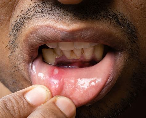 Mouth Ulcers: Types, Causes & Treatment