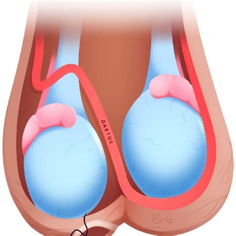 Visual illustration of a normal testis vs a testis with a bell clapper ...