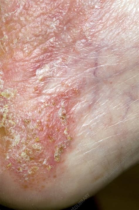 Infected eczema on the foot - Stock Image - C008/3608 - Science Photo ...