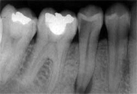 Real-Time Dental Caries detection from X-Ray images | Intel DevMesh