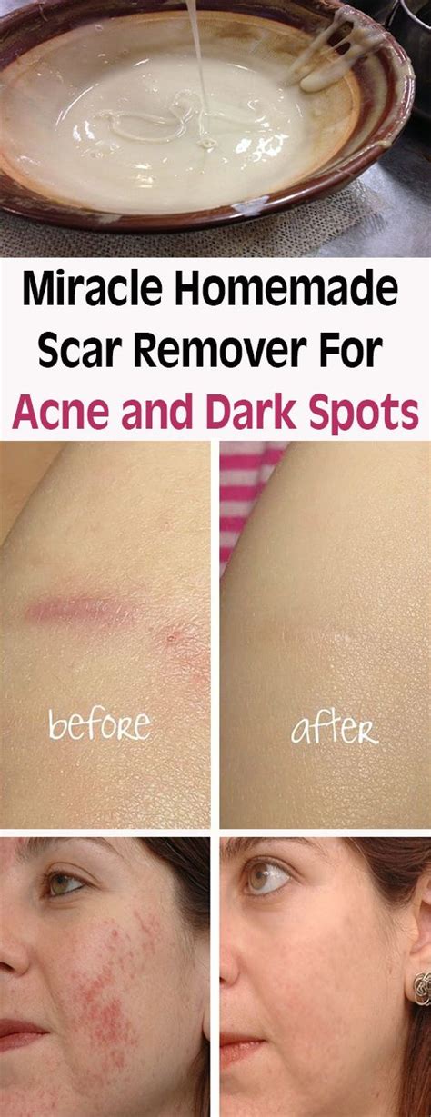 Miracle Homemade Scar Remover For Acne and Dark Spots – Let's Tallk ...