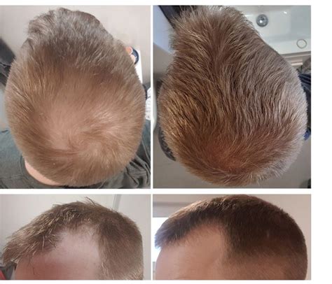 Finasteride Results: Timeline, Photos, Before & After