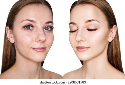 Young Woman Before After Acne Treatment Stock Photo 2208531583 ...