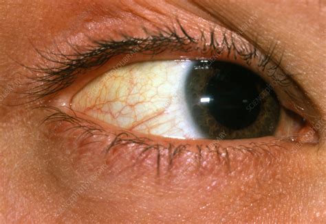 Yellowish Color Around Eyes | geoscience.org.sa