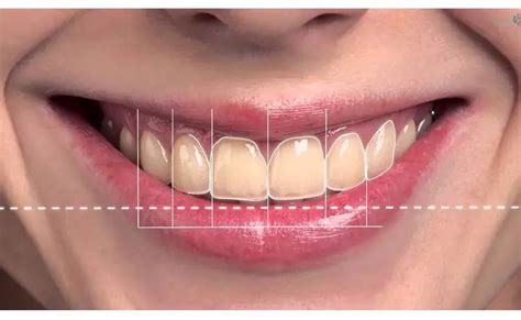 Smile Design and Correction - Sri Sai Indira Dental