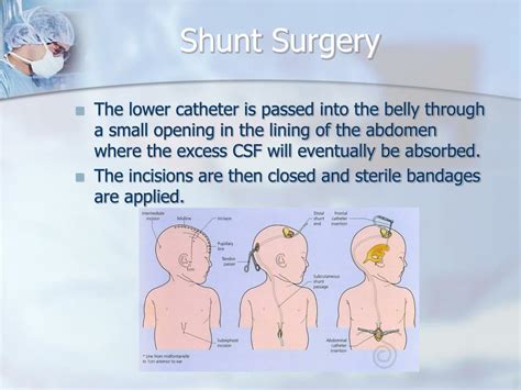 PPT - Hydrocephalus & Shunts PowerPoint Presentation, free download ...