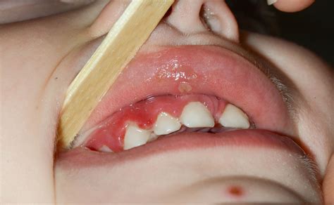 Gum Disease (Gingivitis) in Children - Pediatric Dental Specialist