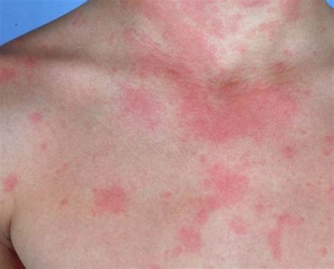 Urticaria Rash Causes