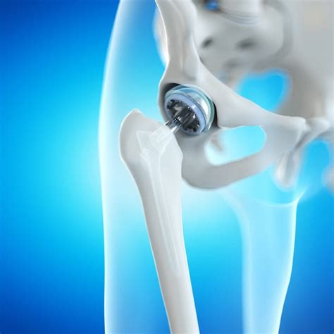 ANTERIOR VS. POSTERIOR HIP REPLACEMENT | Cedar Orthopaedic Surgery ...