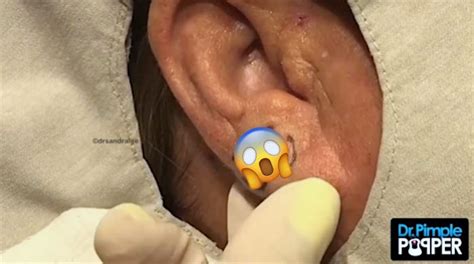 Dr. Pimple Popper Squeezes Out an Earlobe Cyst - Business Insider