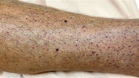 Mild Petechiae Legs