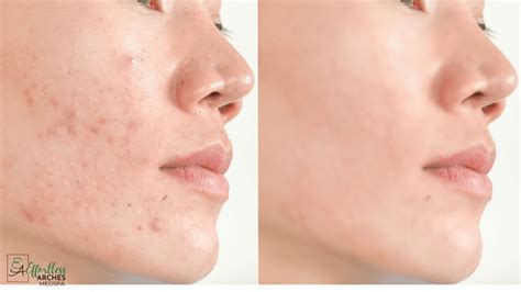 Acne Scars vs Hyperpigmentation: What's The Difference?