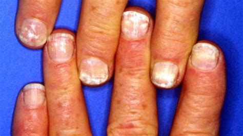 White Spots on the Nails: Causes and More