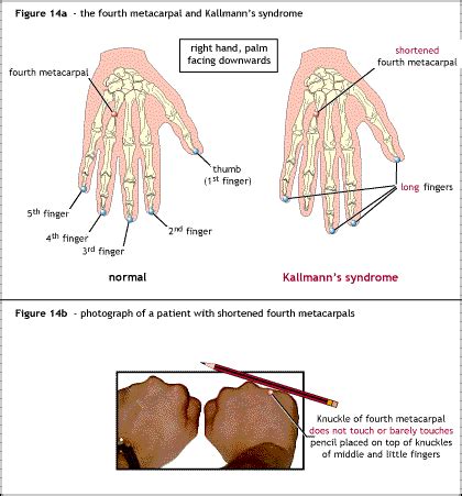 Delayed puberty