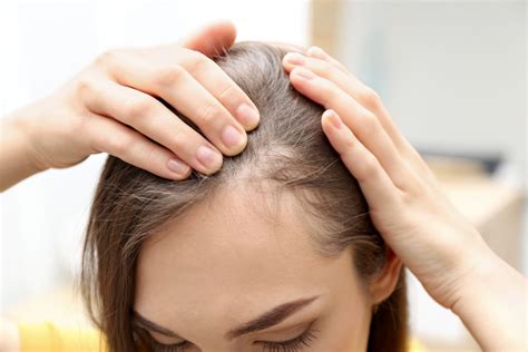 How to Stop Alopecia Areata from Getting Worse