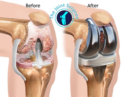 Is Knee Replacement Surgery Common Knee Replacement | Hot Sex Picture