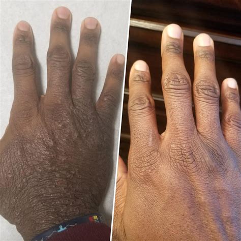 Mild Eczema Hands