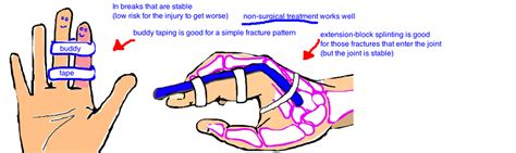 Hand - Finger Fracture (phalanx) — Bone Talks