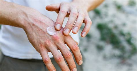 Dry Skin On Hands - Causes, Prevention & Cure | O’Keeffe’s | O'Keeffe's ...